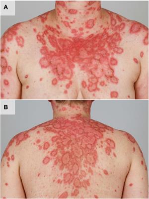 Current concepts of photosensitivity in cutaneous lupus erythematosus